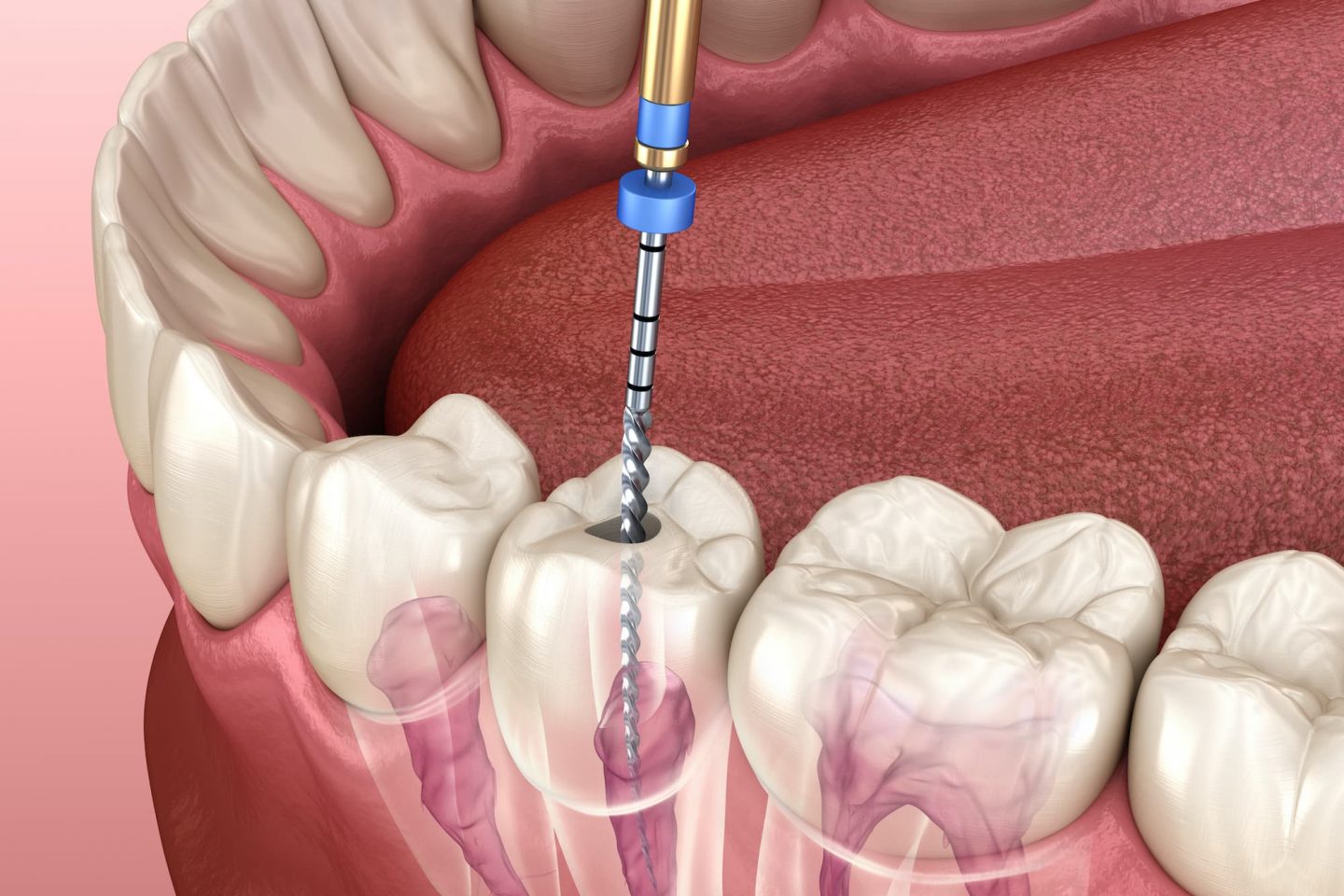 Root Canal Treatments